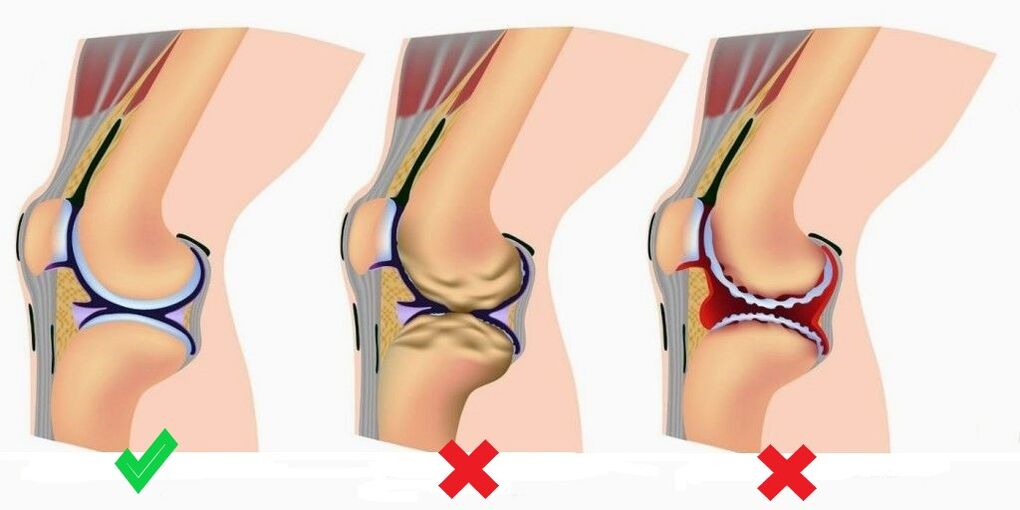 A Depanten megakadályozza az ízületi gyulladás és az arthrosis kialakulását