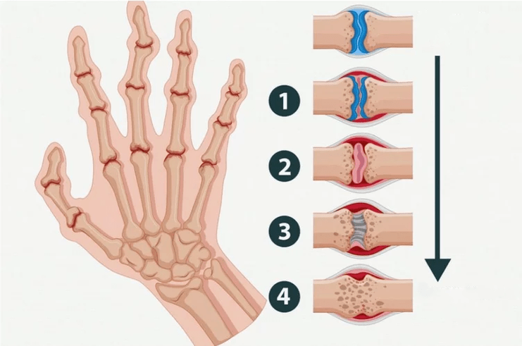 A rheumatoid arthritis szakaszai, amelyek az ujjak ízületeit érintik