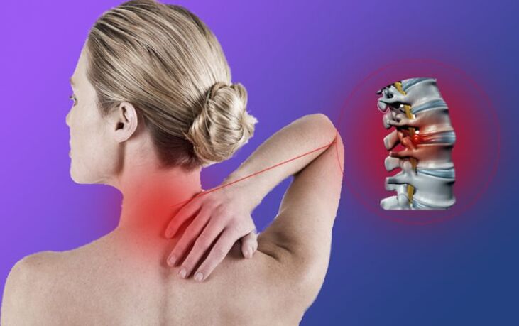 A gerinc gyulladása nyaki osteochondrosissal