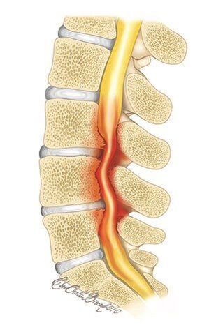 A mellkasi gerinc osteochondrosisával a gerinccsatorna összenyomódása következik be