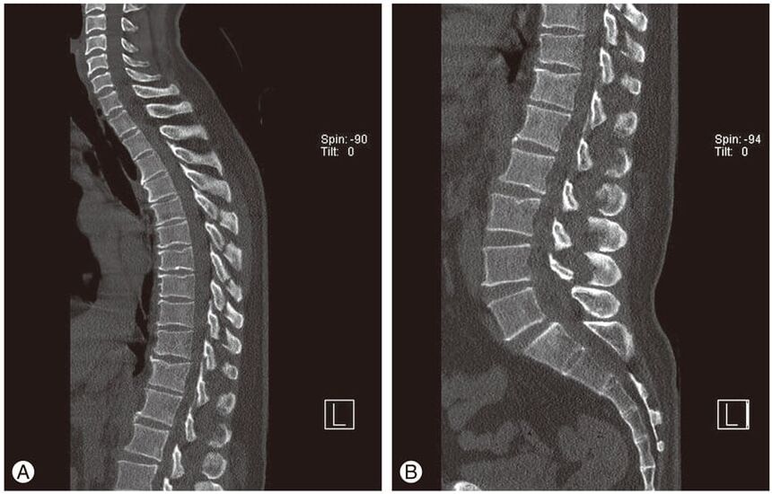 Az intervertebrális lemezek deformációja MRI-felvételeken mellkasi osteochondrosisban