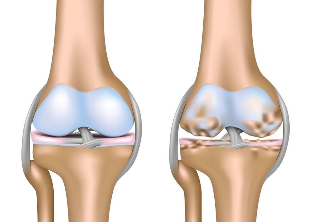 az ízületek arthrosisának súlyosbodása