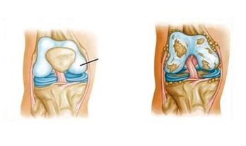 patológiás változások a térd arthrosisában