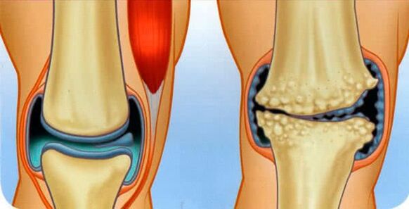 egészséges ízület és ízületi arthrosis