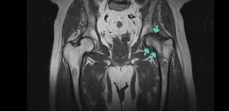 A csípőízület osteoarthritise az MRI-n