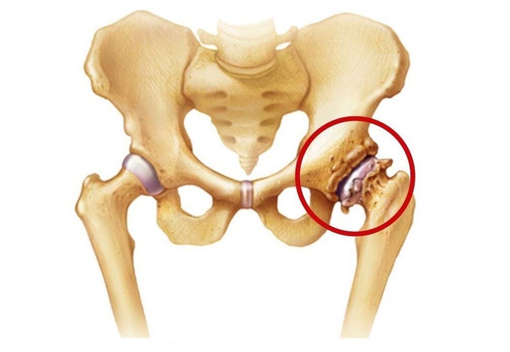 Arthrosis által érintett csípőízület