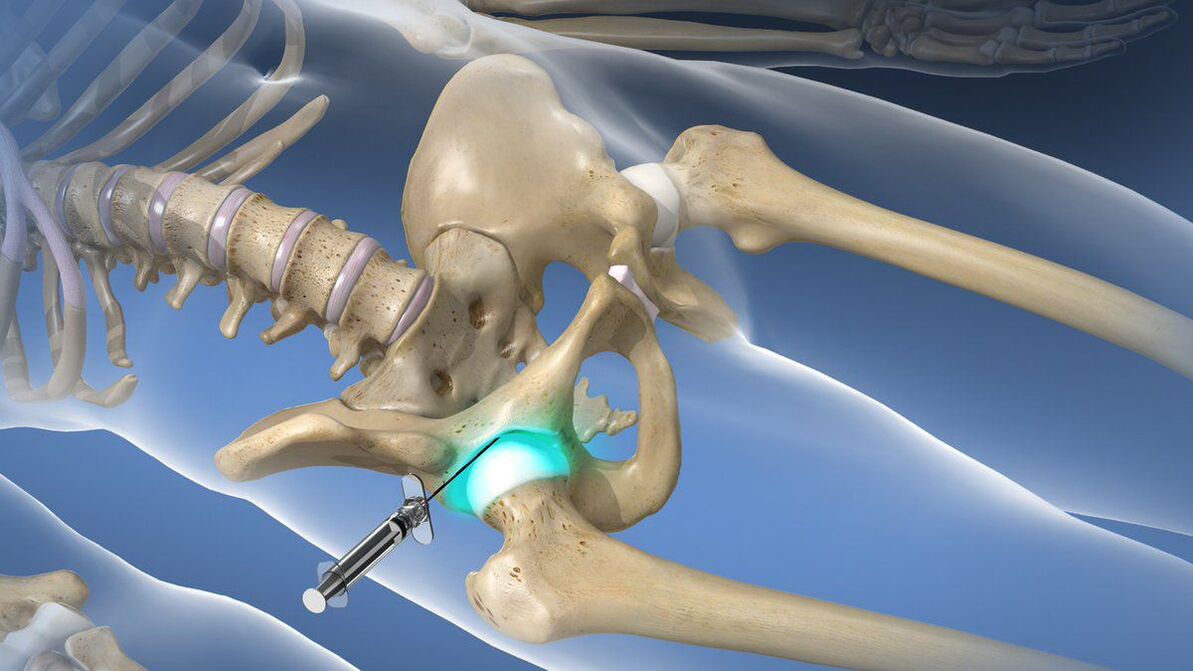 Intraartikuláris blokád csípőízületi arthrosist kísérő súlyos fájdalom esetén