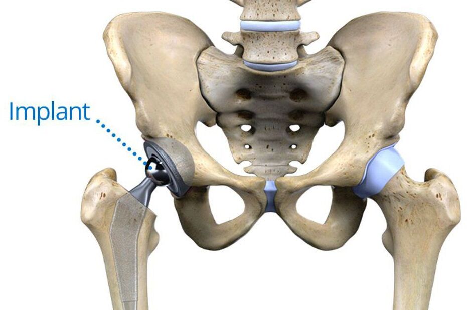 Teljes csípőízület arthrosis esetén