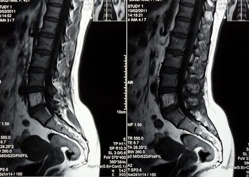 A lumbosacralis gerinc MRI-je a derékfájás diagnosztizálására